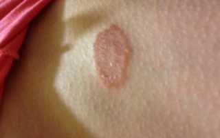 Что такое Итразол и с чем он борется?