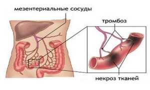 Мезентериальный тромбоз — симптомы и лечение