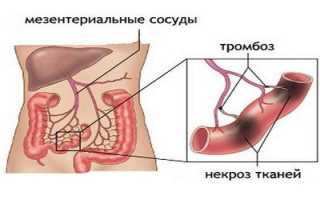Мезентериальный тромбоз — симптомы и лечение