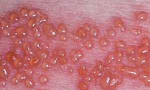 Типы герпеса: симптомы и лечение вируса