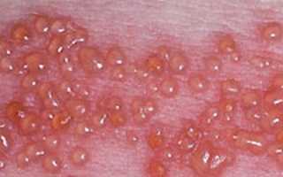 Типы герпеса: симптомы и лечение вируса