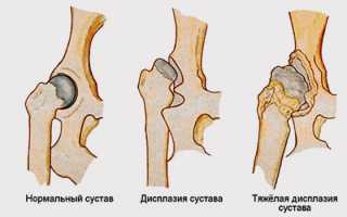 УЗИ тазобедренного сустава у взрослых