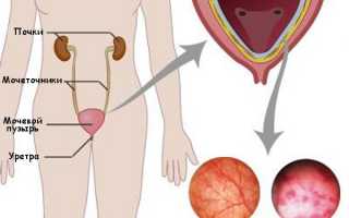 Цистит при климаксе: причины и признаки