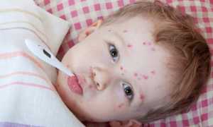 Ветрянка при беременности