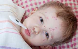 Ветрянка при беременности