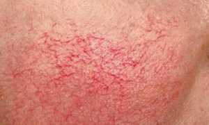 Сосудистые звездочки: что это ?