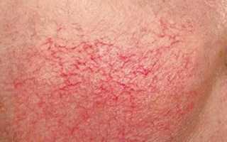 Сосудистые звездочки: что это ?