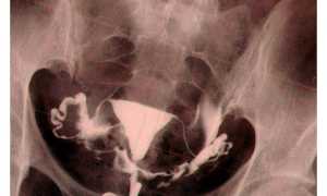 Спайки в маточных трубах: симптомы, лечение и беременность