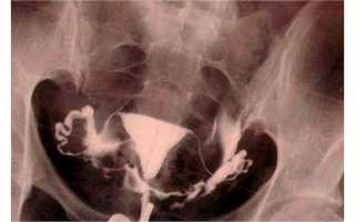 Спайки в маточных трубах: симптомы, лечение и беременность