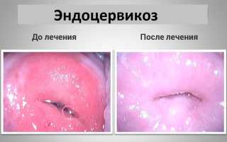 Эндоцервикоз шейки матки: основные причины, симптомы и лечение