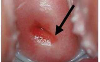 Покраснение шейки матки: причины и скрытые опасности