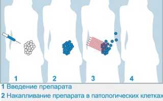 Как осуществляется фотодинамическая терапия шейки матки?