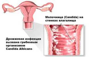 Как связаны эрозия шейки матки и молочница?