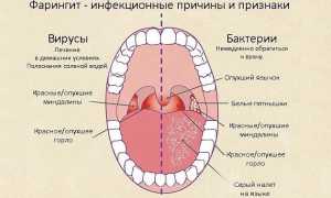 Фарингит у детей и взрослых — симптомы и лечение