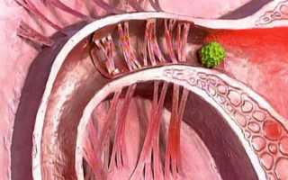 Могут ли спайки стать непреодолимой преградой беременности?