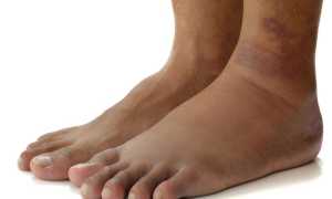 Цирроз печени – симптомы у женщин, стадии развития