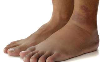 Цирроз печени – симптомы у женщин, стадии развития