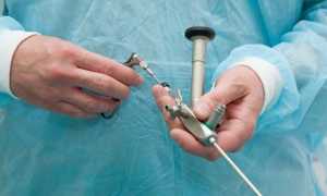 Диагностика эндометриоза, симптомы у женщин