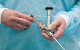 Диагностика эндометриоза, симптомы у женщин