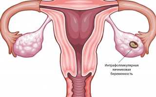 Внематочная беременность в яичнике: симптомы, диагностика и лечение