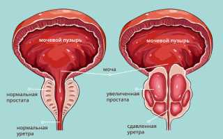 Какая должна быть простата на ощупь здоровая