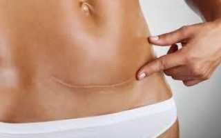 Несостоятельность маточного рубца после кесарева: суть проблемы и ее решение