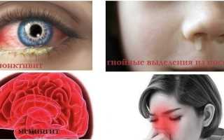 Полипозный гайморит у детей и взрослых — симптомы и лечение