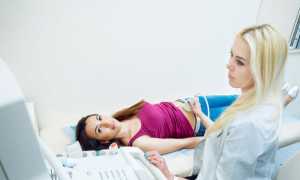 Перекрут ножки кисты яичника