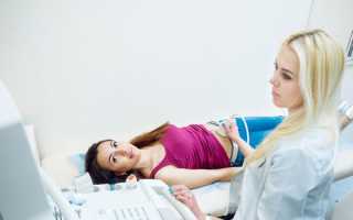 Перекрут ножки кисты яичника