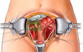 Операция Вертгейма при раке шейки матки: метод и его характеристики