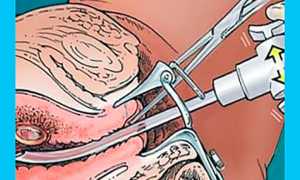 Хронический эндометрит: можно ли забеременеть