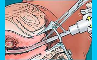 Хронический эндометрит: можно ли забеременеть