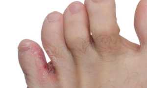 Принципы лечения грибкового поражения между пальцами ног