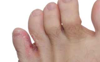 Принципы лечения грибкового поражения между пальцами ног