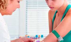 Что такое МФЯ (мультифолликулярные яичники)?