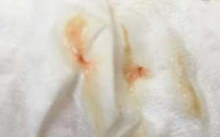 Почему выделяется сукровица при беременности на ранних сроках?