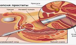 Диета после биопсии простаты — разрешенные продукты и правила питания