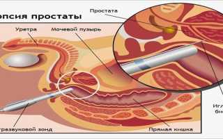 Диета после биопсии простаты — разрешенные продукты и правила питания