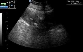 Кальцинат в матке: причины, симптомы и лечение