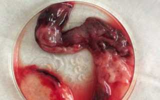 Гематома при беременности в матке – опасность для малыша