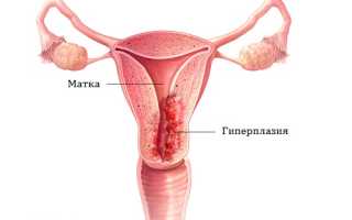 Какие бывают месячные при гиперплазии эндометрия?