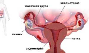 Эндометриоз — что это такое