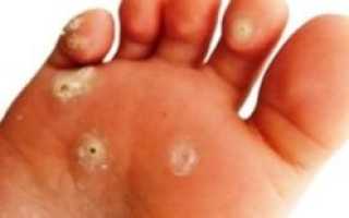 Что такое дисгидротическая форма грибка стопы и как ее лечить