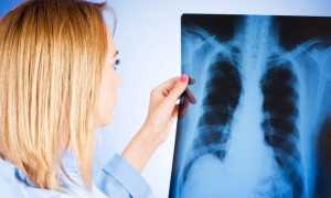 Легочное кровотечение – причины патологии