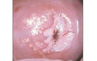 Лейкоплакия шейки матки при беременности: чем опасна патология?