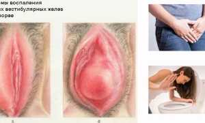 Гонорея — возбудитель, симптомы, диагностика, лечение и профилактика