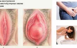 Гонорея — возбудитель, симптомы, диагностика, лечение и профилактика