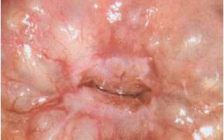 Почему развиваются множественные кисты на шейке матки?