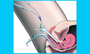 МСГ маточных труб