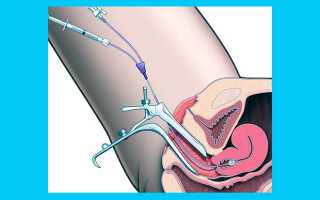 МСГ маточных труб